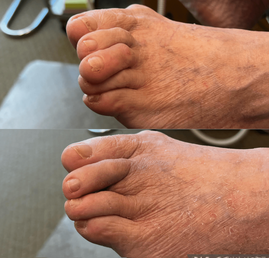 Elective_3rd_toe_amputation_new