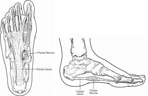 Plantar Fibroma